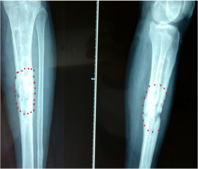 Study of the extent of surgical osteotomy in Cierny-Mader stages III and IV chronic osteomyelitis.