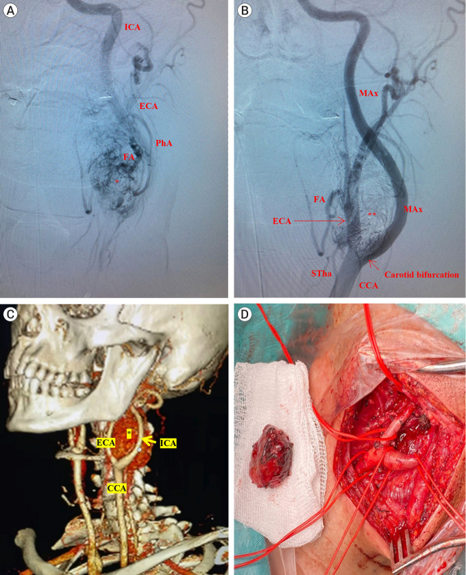 Preoperative embolization of brain, head, and neck tumors: Single center experience and literature review.
