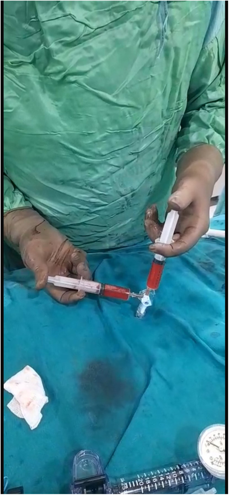 Contrast echocardiography with a physiological contrast agent for alcohol septal ablation.