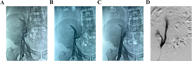 Case Report: Application of the AngioJet thrombectomy system in acute lower extremity deep vein thrombosis complicated by transplanted renal vein thrombosis (report of two cases).