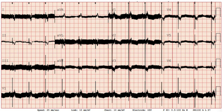 Management of Ventricular Arrhythmias in Patients with Left Ventricular Assist Devices: Pathophysiology, Risk Stratification, and Ablation Strategies.