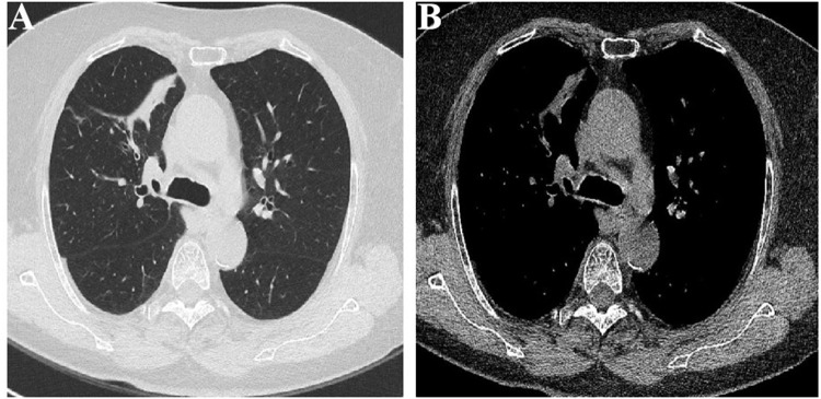 CT-Occult Primary Benign Tracheobronchial Neoplasms: A Single-Center 40-Case Clinicopathologic Series.
