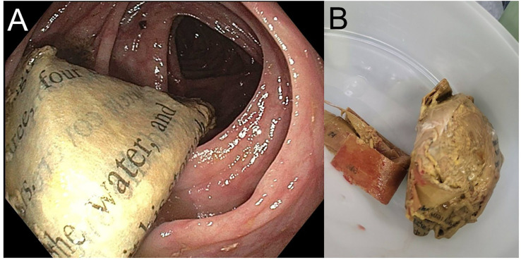 Situational xylophagia from chronic anemia: case report.