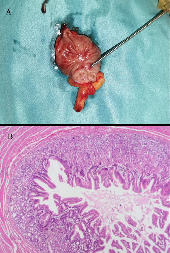 Massive Gastrointestinal Hemorrhage in an Adult Caused by Meckel's Diverticulum: A Case Report.