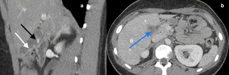Actinomycosis of the Gallbladder in a Young Diabetic Woman with Acute Lithiasis Cholecystitis: A Case Report and Review of the Literature.