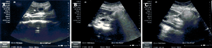Comparison of gastric emptying of solid and semi-solid meals using real-time ultrasonography in healthy Sri Lankan adults.