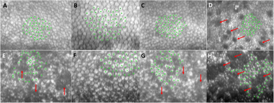 Biocompatibility of Genetically-Engineered Pig Cornea in Corneal Xenotransplantation: Preliminary In Vitro Study.