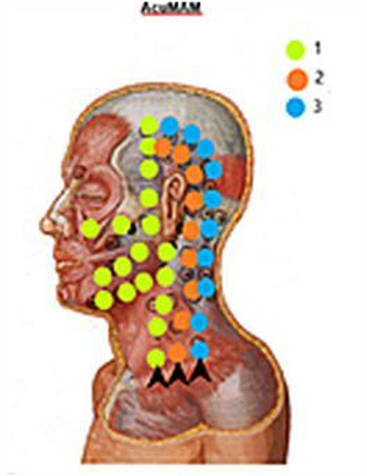 Clinical Improvement in a Case of Alternating Hemiplegia of Childhood After Cerebral Lymphatic Drainage.