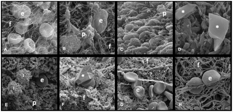 Optical and Scanning Electron Microscopy Thrombus Findings in Patients with STEMI Undergoing Primary Versus Rescue PCI.