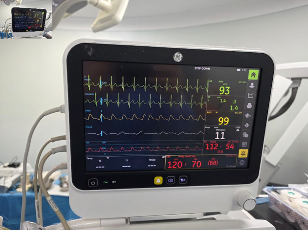 Ketofol (Ketamine-Propofol) in Pediatric Awake Neurosurgery: An Anesthetic Perspective.