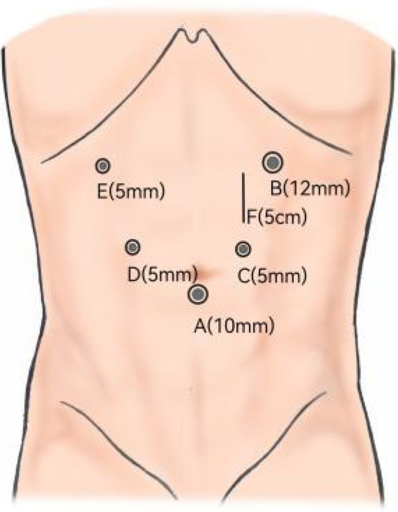 Intracorporeal circular-stapled gastroduodenostomy for billroth I reconstruction in total laparoscopic distal gastrectomy.