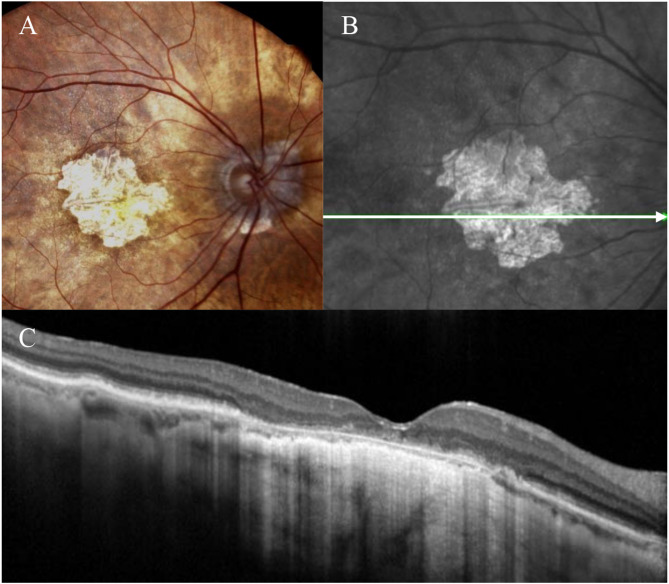 Characteristics of geographic atrophy secondary to age-related macular degeneration in Korean patients.