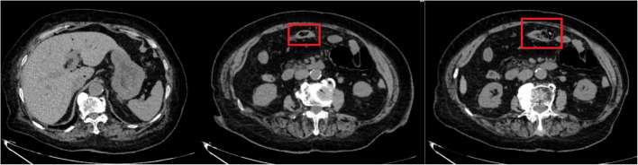 Non-enhancing bowel dilatation and secondary ileus on CT as a surgical red flag in geriatric patients with atypical presentations.