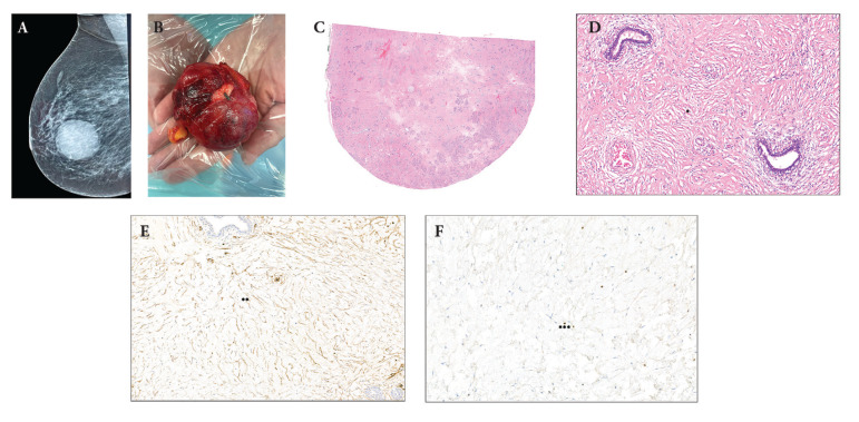 Pseudoangiomatous Hyperplasia of Mammary Stroma: Insights from Two Cases, Data Update and Management Algorithm.
