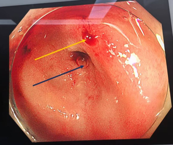 Massive Gastrointestinal Hemorrhage in an Adult Caused by Meckel's Diverticulum: A Case Report.