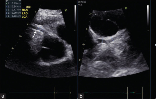 Echocardiographic Evaluation in Kawasaki Disease.