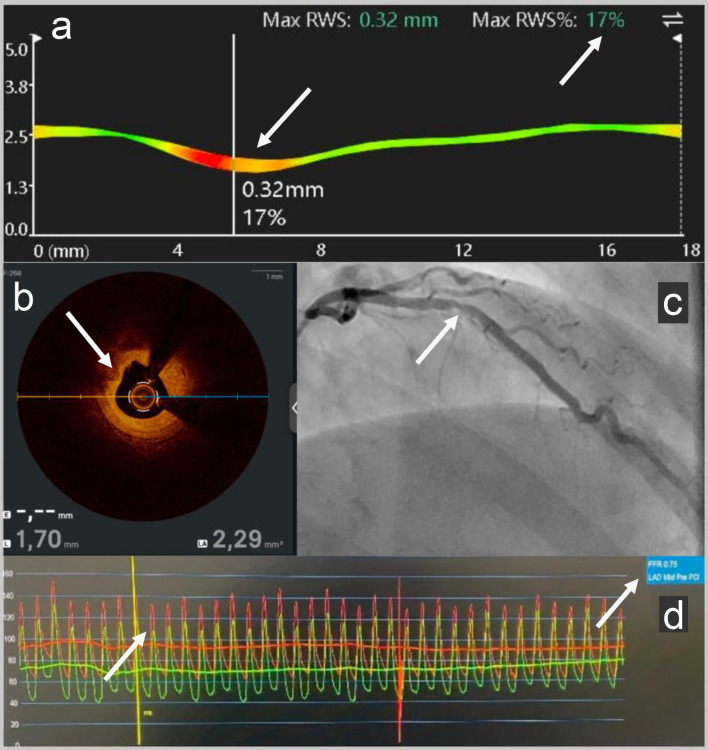 Persistent Impairment of Coronary Microvascular Dysfunction After Percutaneous Coronary Intervention in an Ice Swimming Champion.