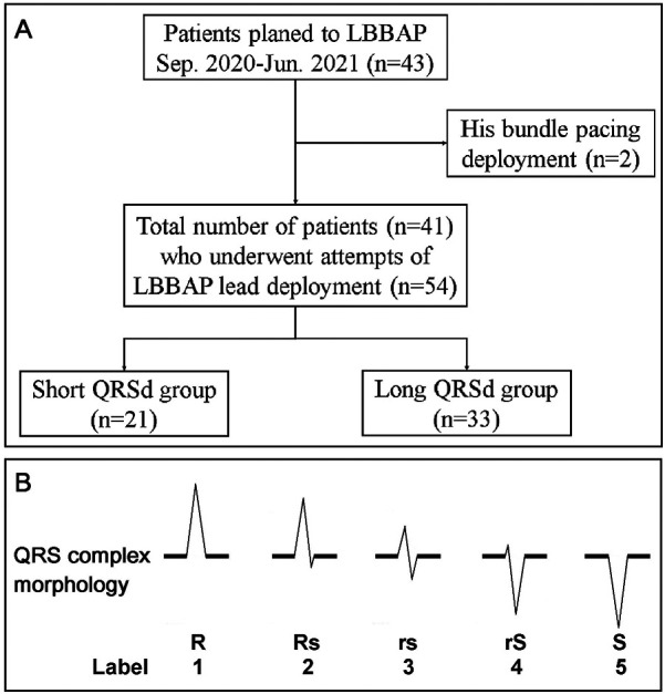 Role of peri-deployment right ventricular paced-ECG in left bundle area pacing.
