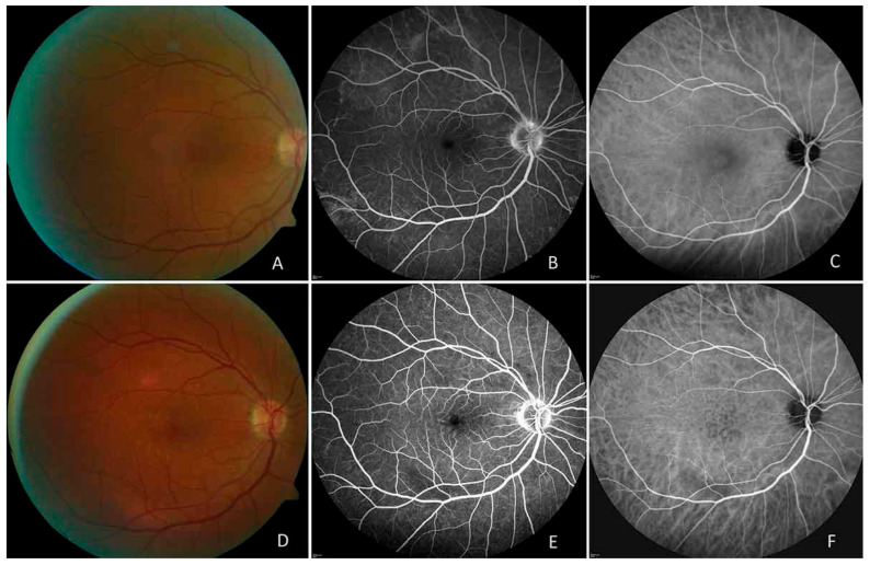 Influenza-Associated Ocular Complications: A Comprehensive Review of Viral Subtypes, Clinical Presentations, and Vaccination Risks.
