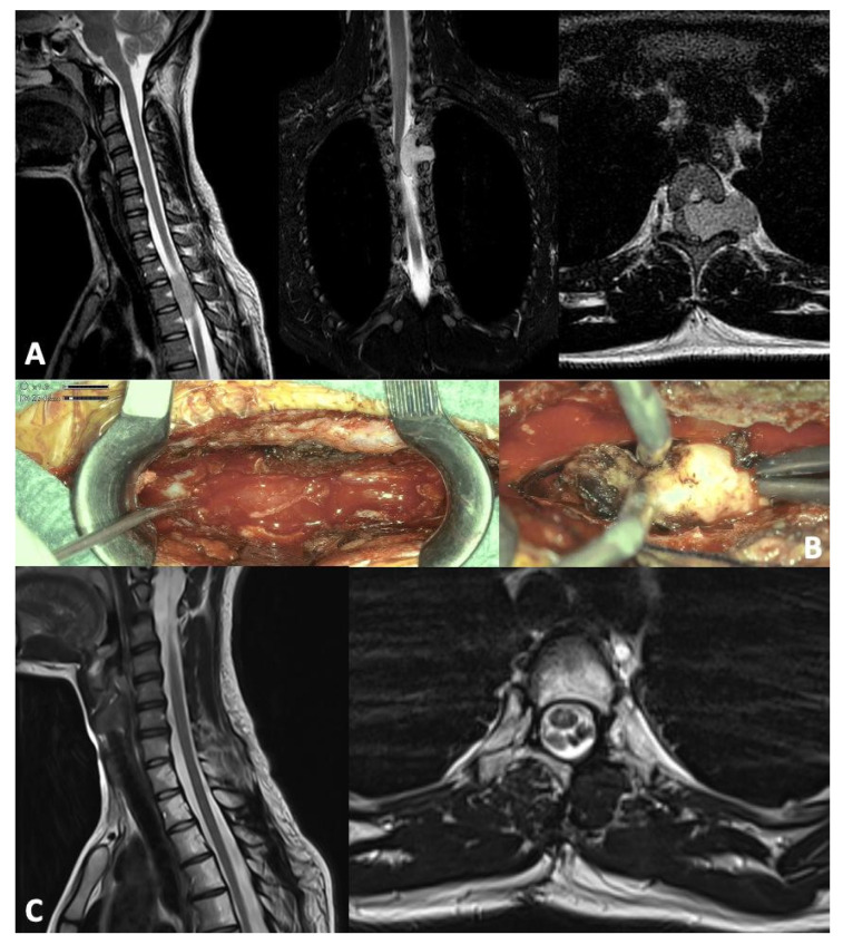 Pediatric Spinal Solitary Fibrous Tumor: A Systematic Review of a Rare Condition.