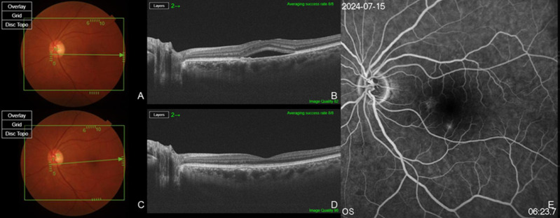 Efficacy of Intravitreal Brolucizumab for Chronic Central Serous Chorioretinopathy: A Pilot Study.