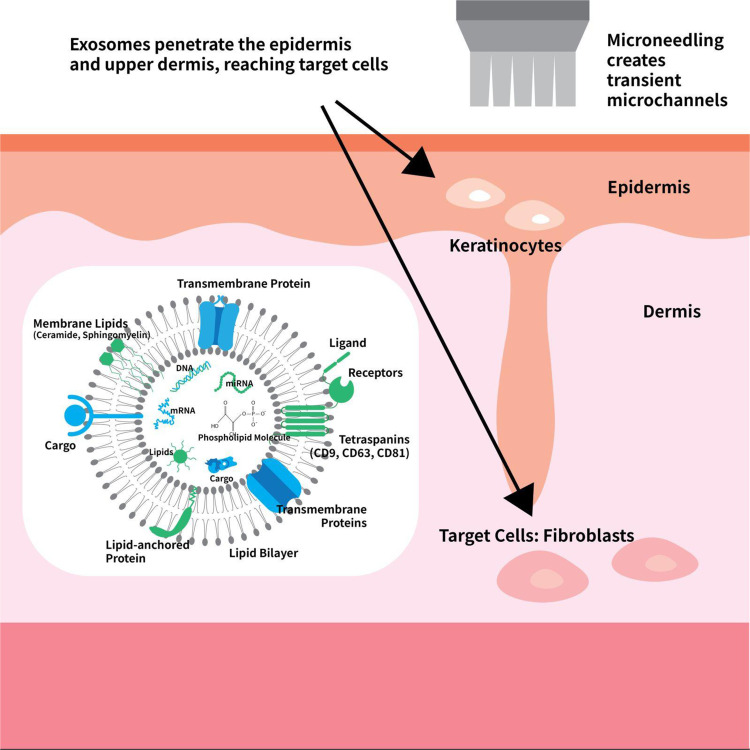 Preliminary Histological Evidence of Epidermal and DEJ Remodeling with Microneedling-Assisted Topical Exosome Therapy: A Single-Subject Case Report.