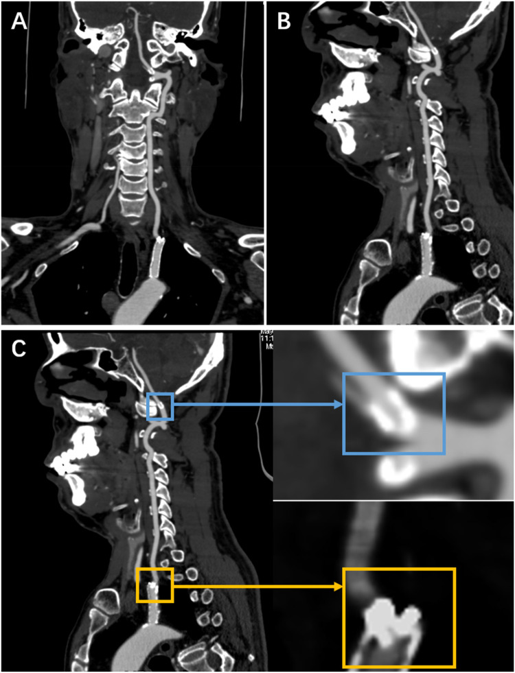 Conservative management of asymptomatic vertebral artery stent fracture with fragment embolisation to V3 segment: a case report.