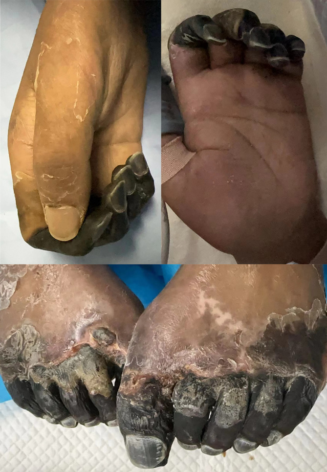 Prolonged Acute Kidney Injury and Symmetrical Peripheral Gangrene: A Rare Case Report of Acute Promyelocytic Leukemia.