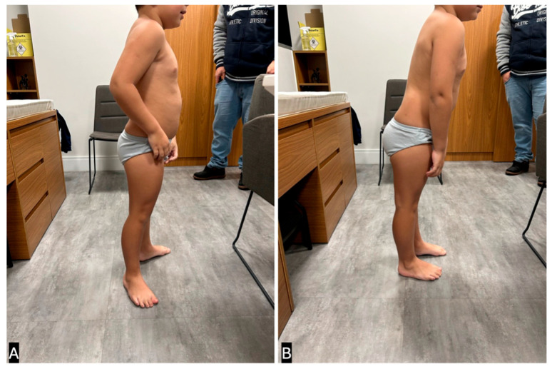 The Autistic Toe Walking: A Narrative Review for Interventions and Comparison with Idiopathic Toe Walking.