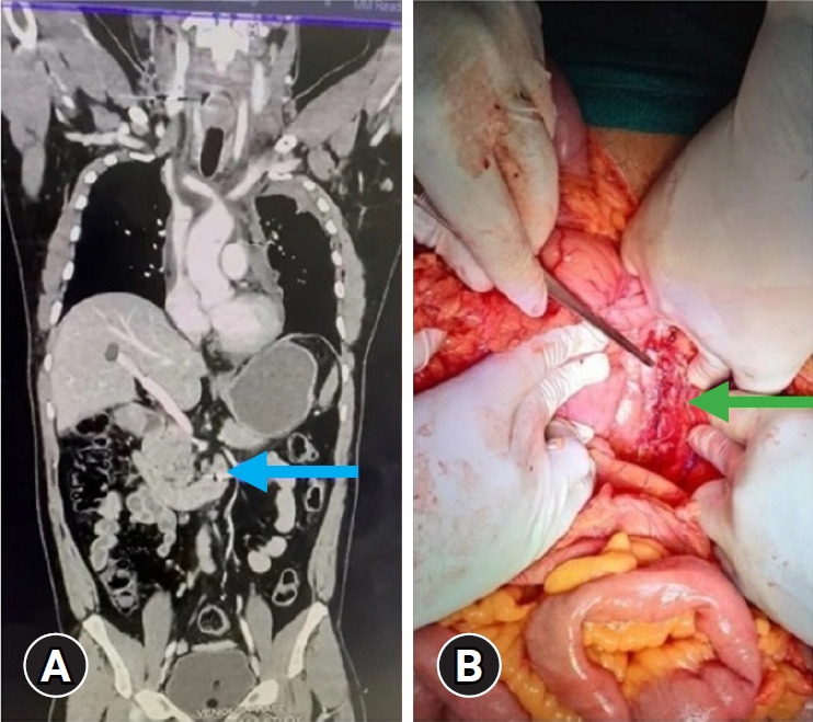 Inferior vena cava injuries at a level I trauma center: a case series.