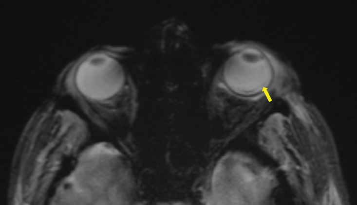MRI Findings of Endogenous Endophthalmitis as a Complication of Pneumococcal Meningitis.