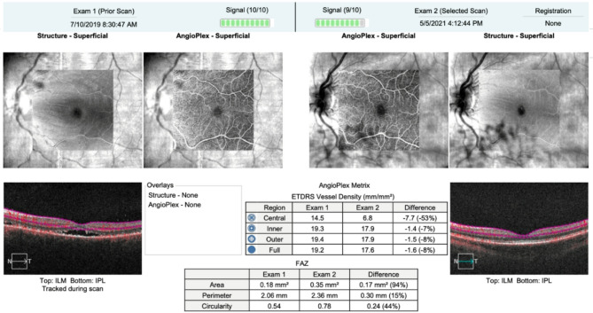 Clinical characteristics and long-term outcomes of Vogt-Koyanagi-Harada disease in pediatric age group.