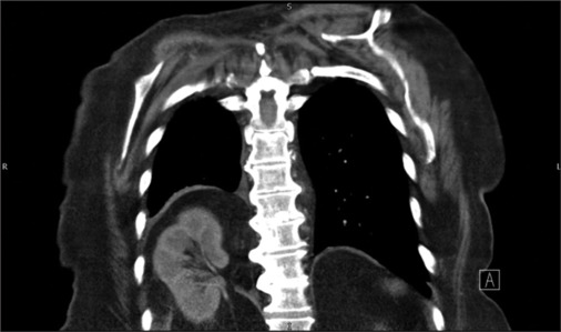 Mediastinal mass: Diagnostic dilemma on acute medical take.