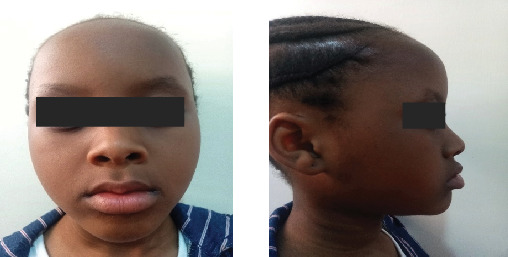 Oligodontia Management in a Resource-Limited Setting: Two Case Reports and Review of Literature.