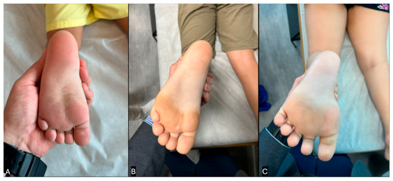 The Autistic Toe Walking: A Narrative Review for Interventions and Comparison with Idiopathic Toe Walking.
