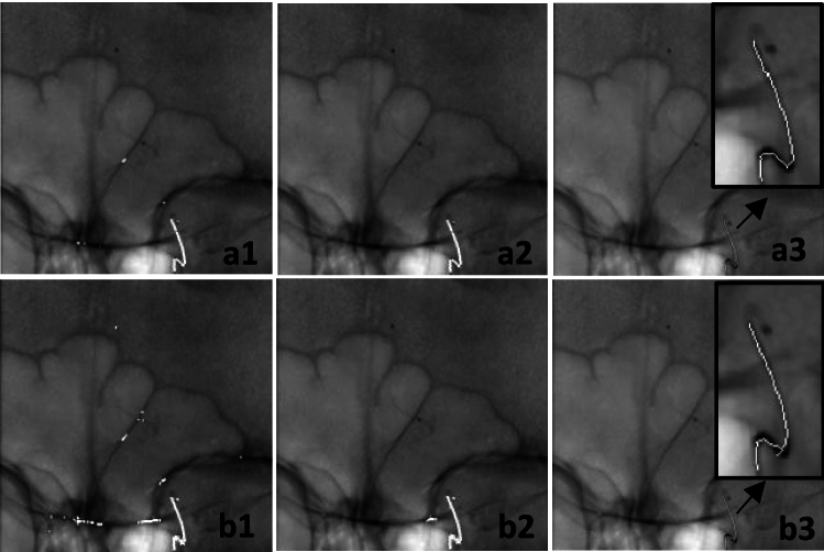 Semi-automatic segmentation of elongated interventional instruments for online calibration of C-arm imaging system.