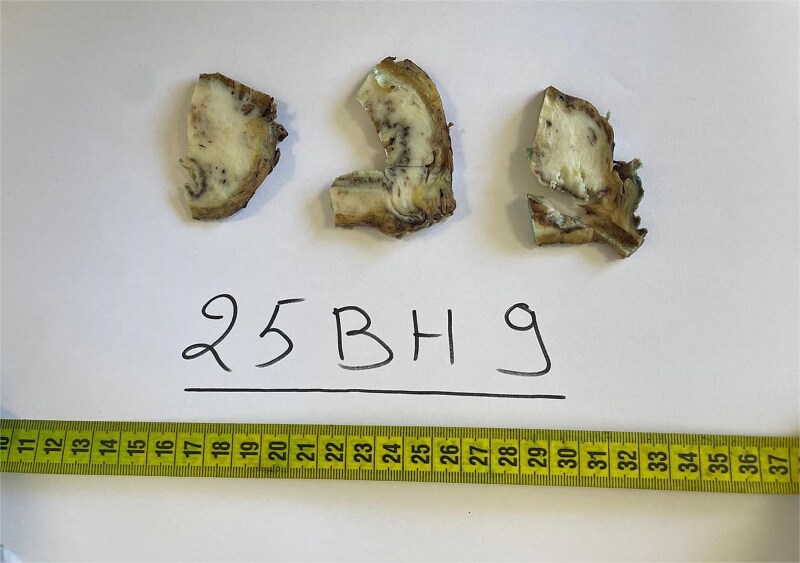 Malignant triton tumor of the bladder with fatal outcome: a rare case report.