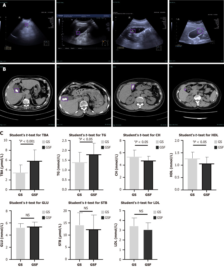 Gallstone and bile microbiota: A case-control study based on 16S rRNA gene sequencing.