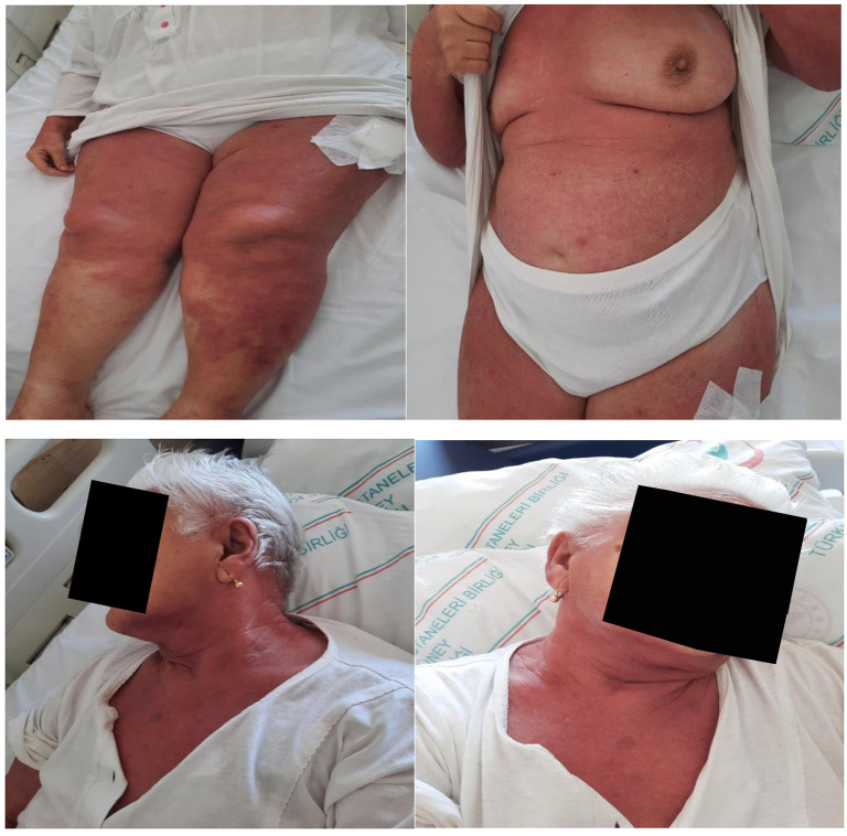 Hypomyopathic Dermatomyositis Presenting with Erythroderma and Concomitant Sjögren's Syndrome: A Rare Case Report.