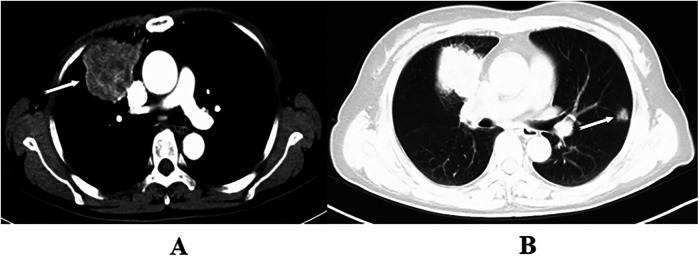 Analysis of the feasibility and health-economics value of simultaneous bilateral pulmonary surgery.