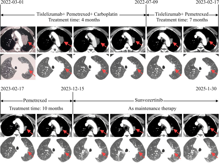 Sunvozertinib Monotherapy in Advanced Lung Adenocarcinoma with <i>EGFR</i> Exon 20 Insertion and High PD-L1 Expression: A Case Report.