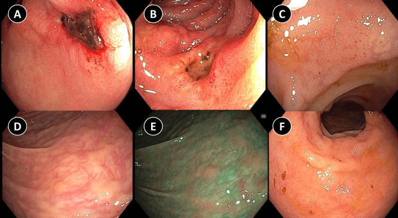 Aggressive systemic mastocytosis: unraveling the mystery behind chronic diarrhea.