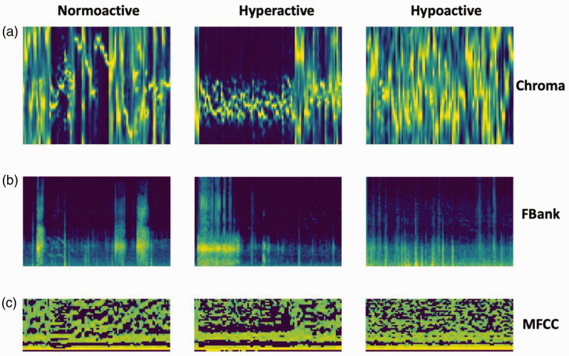 Explainable ResNet-long short-term memory model for the classification of bowel sounds frequency based on multifeature fusion.