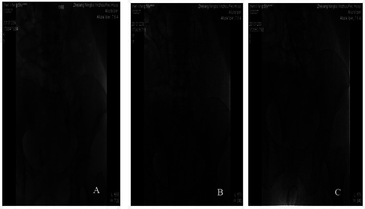 Stepwise cannulation of the small saphenous vein for thrombolysis: A technique to optimize clot removal and reduce the severity of post-thrombotic syndrome.