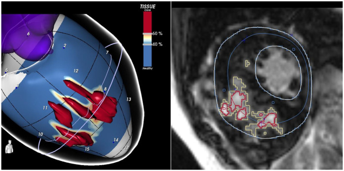 Imaging myocardial scar in hypertrophic cardiomyopathy: advances in CMR and CT.