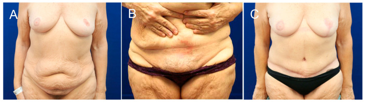 Reimbursement Policies of Swiss Health Insurances for the Surgical Treatment of Symptomatic Abdominal Tissue Excess After Massive Weight Loss: A Retrospective Cohort Study.