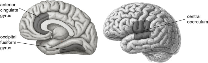 Influence of genetic polymorphism and trauma on cortical structures and PTSD severity: Imaging genetics generalized structured component analysis.