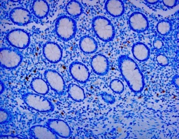 Relationship between adenovirus infection and intussusception via pathological evidence confirms.