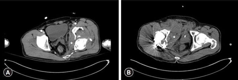Preperitoneal pelvic packing as a salvage operation for postoperative retroperitoneal bleeding with hemodynamic instability after the Kocher-Langenbeck approach to the acetabulum: a case report.