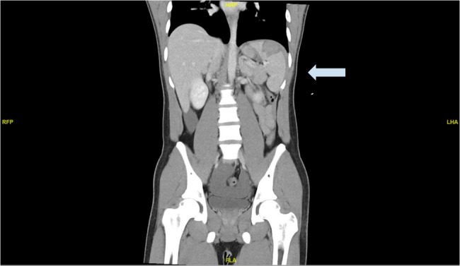 A unique case of atraumatic splenic haematoma likely caused by increased intra-abdominal pressure: a case report.